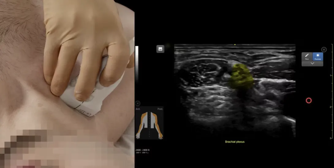Upper Extremity Nerve and Plexus Blocks - Part 1