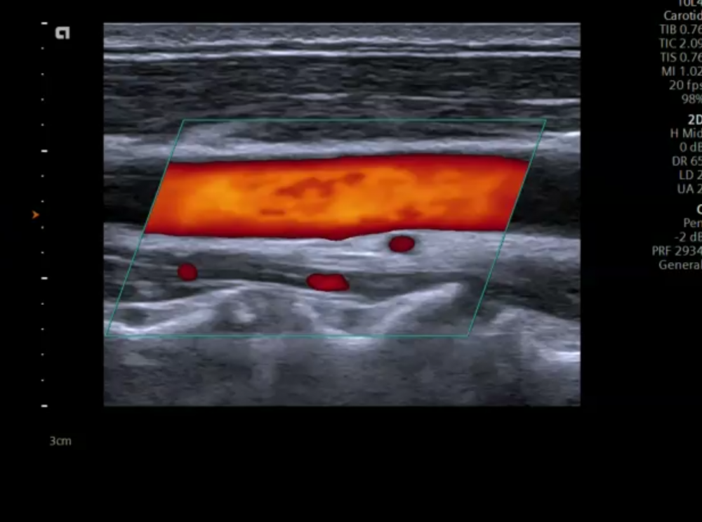 Imaging the carotids - Color Doppler
