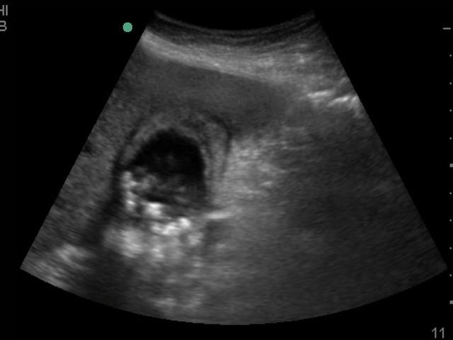 Gallbladder: Anatomy and How to image 