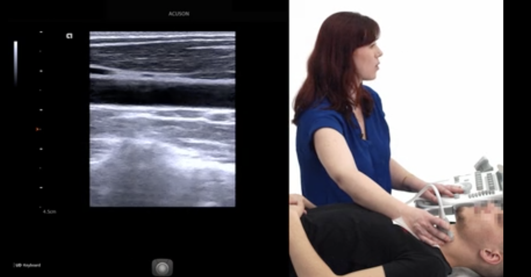 Imaging the carotids - Proximal to middle section