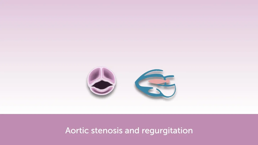 Aortic Valve Disease FocusClass