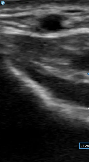 Ultrasound image depth.