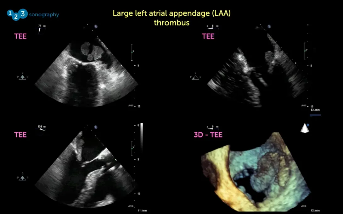 TEE vs TTE | 123sonography