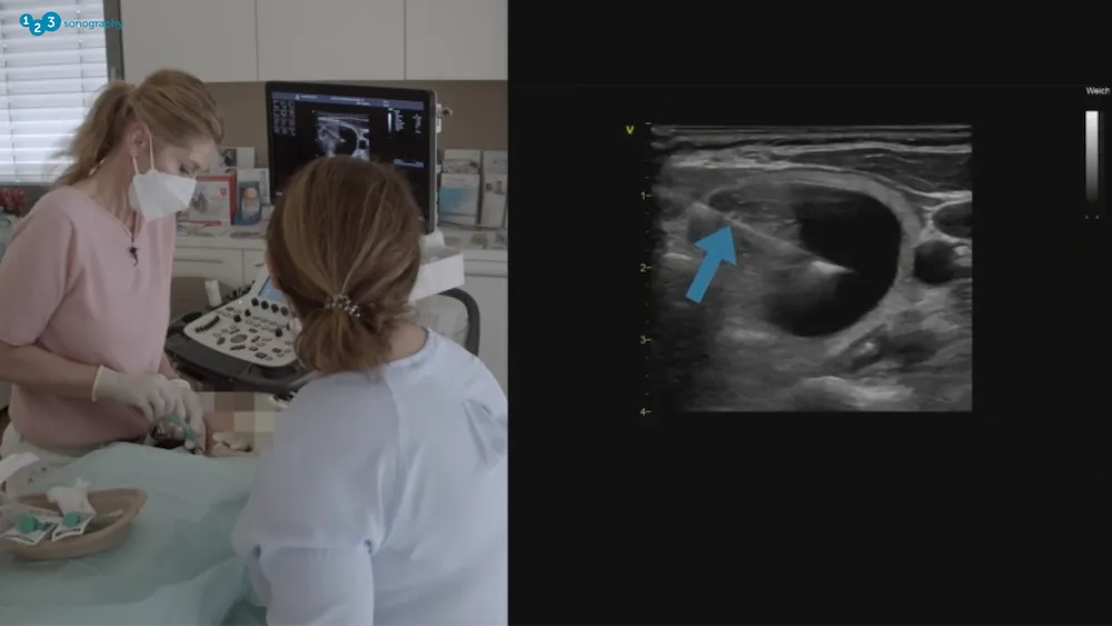 Thyroid Ultrasound: FNA Case Presentation.