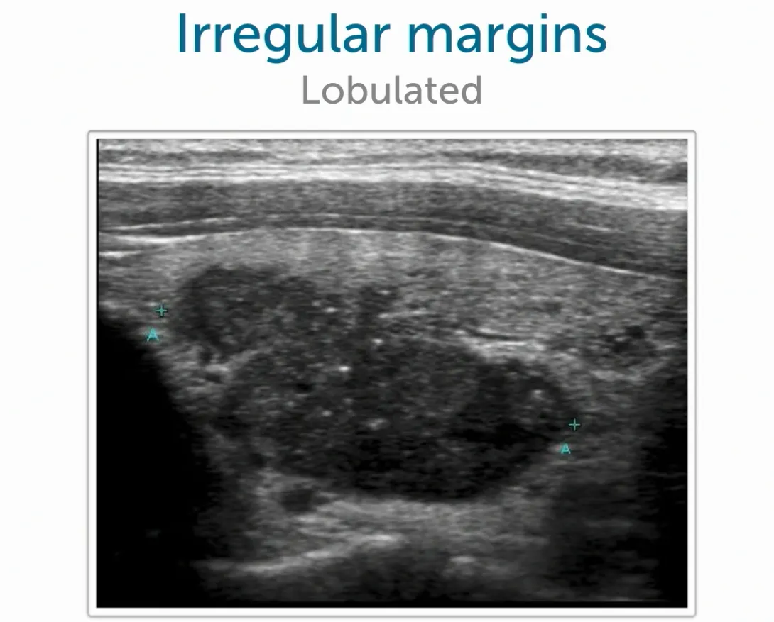 Thyroid Ultrasound: Irregular margins, lobulated.