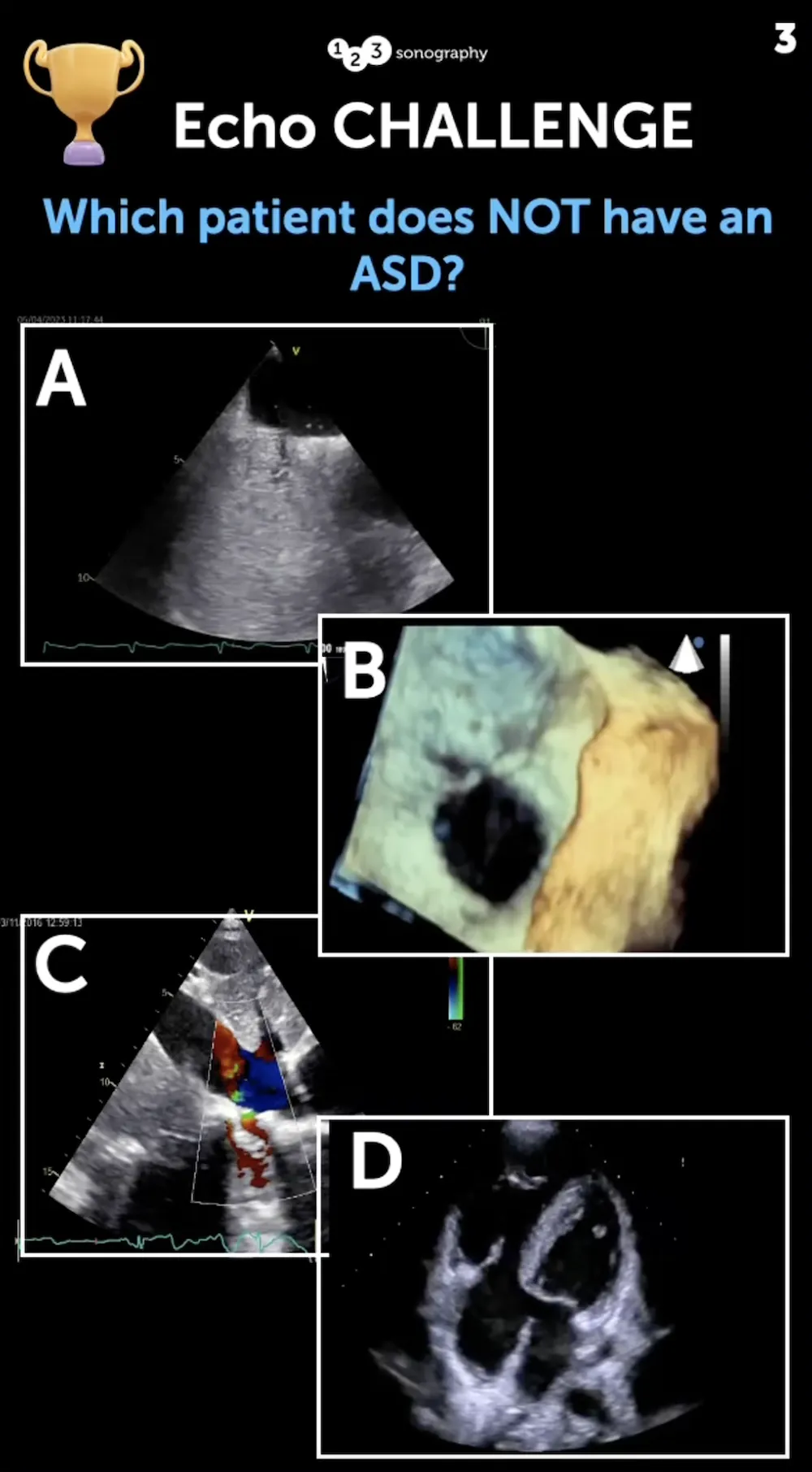 Echo Challenge: Which patient does not have ASD?