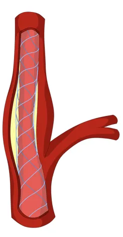 Carotid stenting illustration.