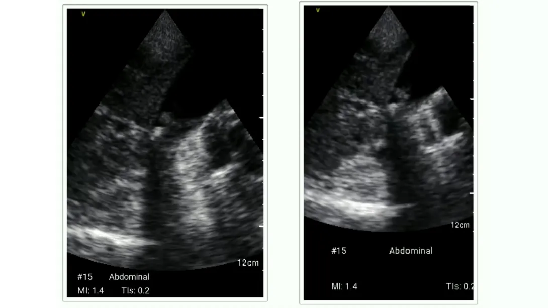 2 Ultrasound images of abdominal ultrasound.