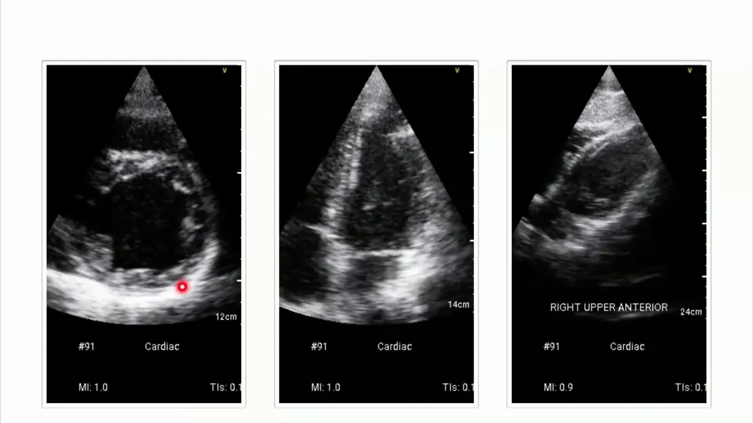 Echocardiogram of a 28-year-old patient with marker.