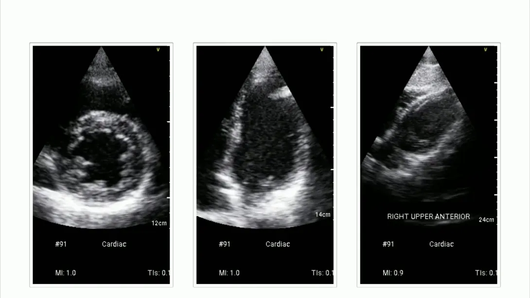 Echocardiogram of a 28-year-old patient.