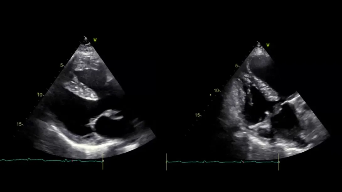 Thumbnail of Tetralogy of Fallot.