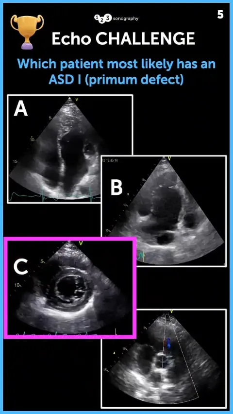 Echo Challenge Answer: Which patient most likely has an ASD I (primum defect) Thumbnail.