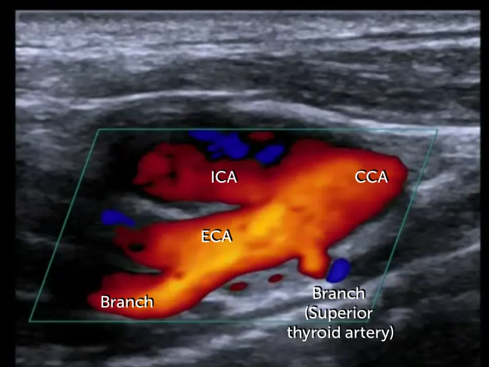 2. Carotid Ultrasound - Anatomy | 123sonography