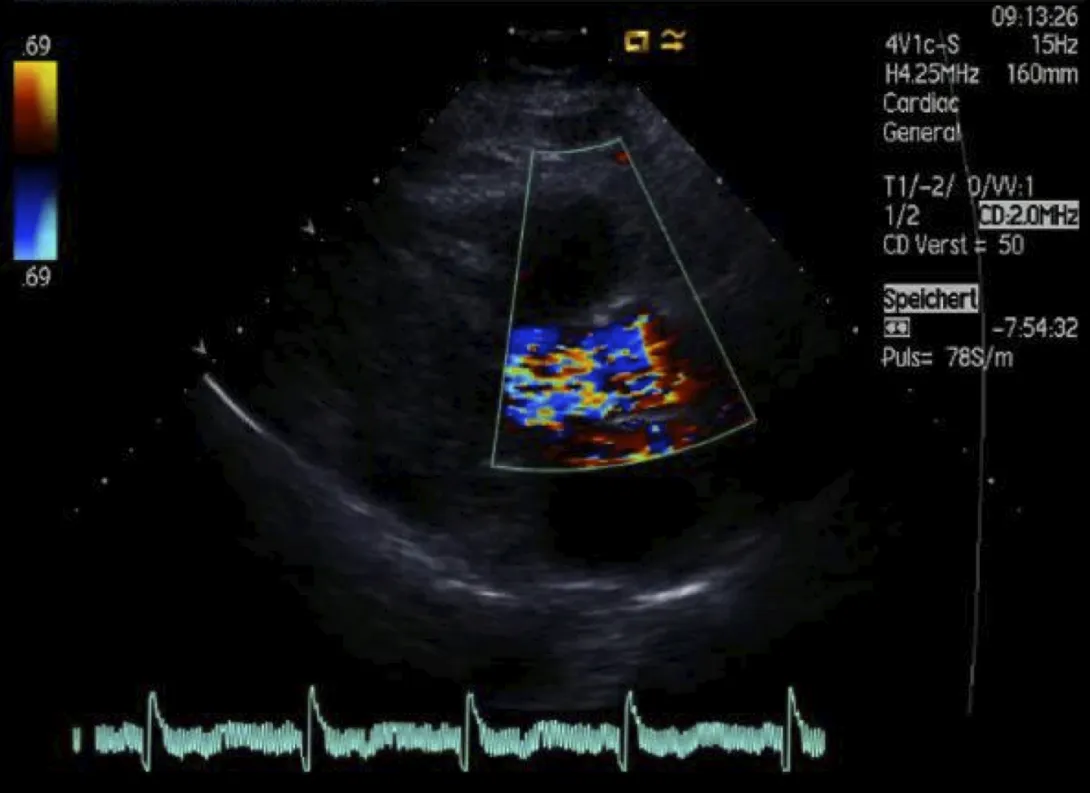 Color Doppler study of a parasternal long axis view. Is it normal?