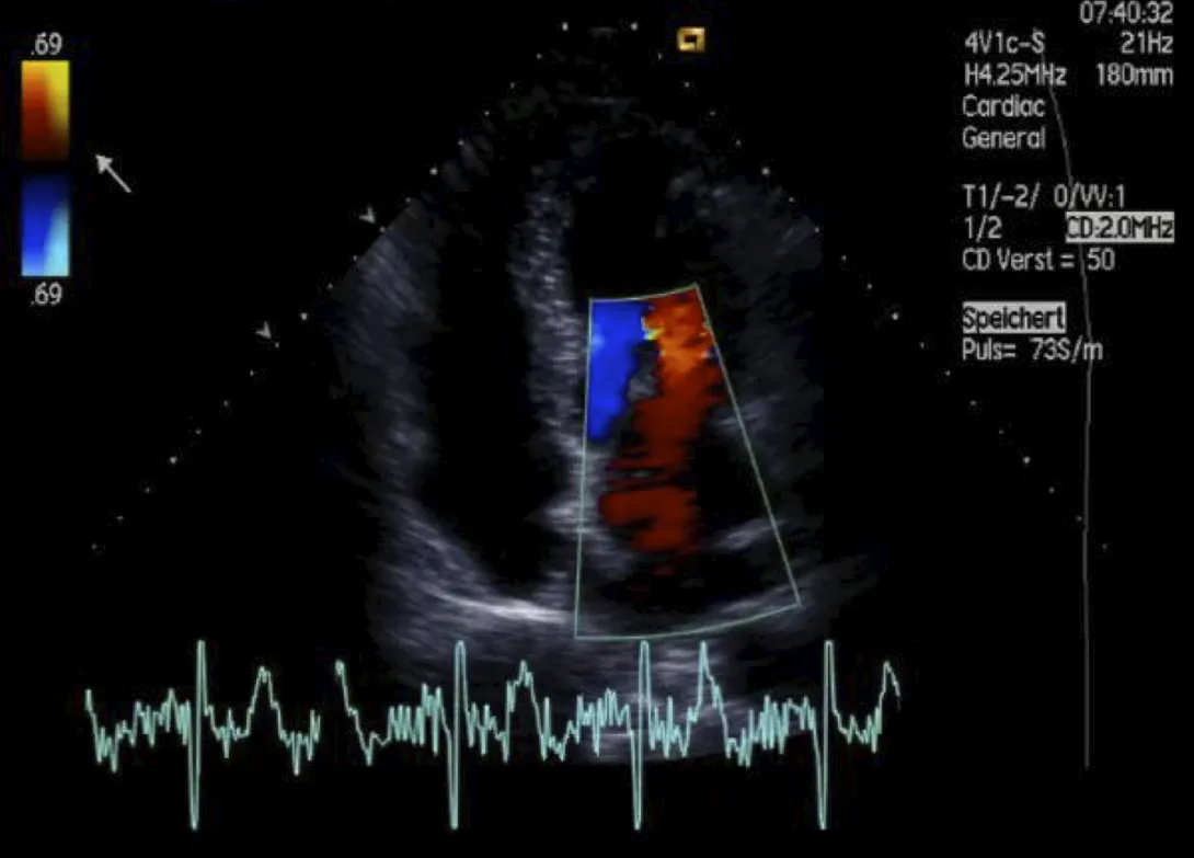 PFO occlusion.