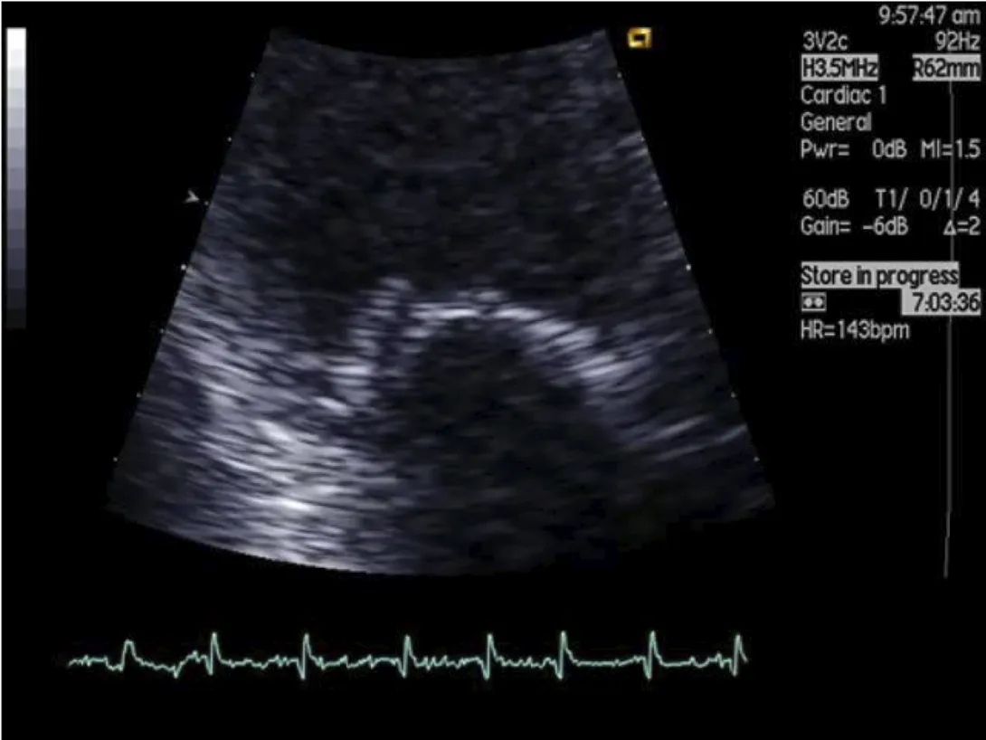 Flail anterior leaflet.