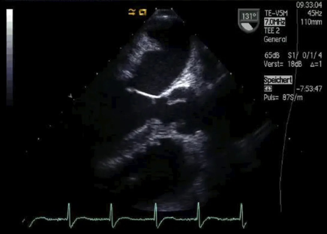Left ventricular outflow tract.