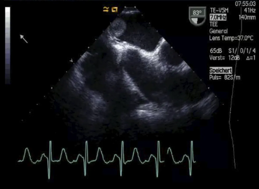 Mobile mass at the interatrial septum.