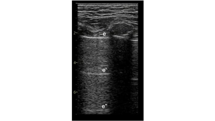 Chest ultrasound image.