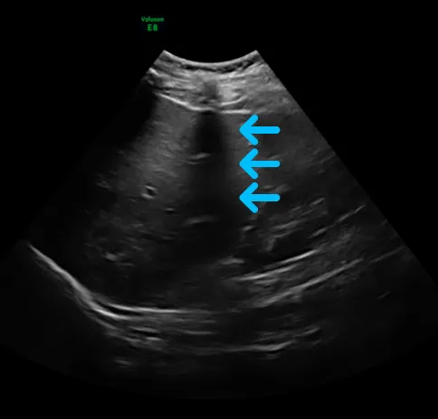 Liver ultrasound image with artifact.