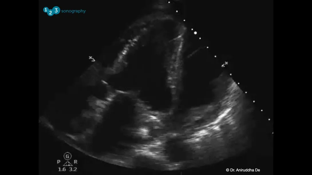 Myocardial Rupture Video 1 thumbnail.