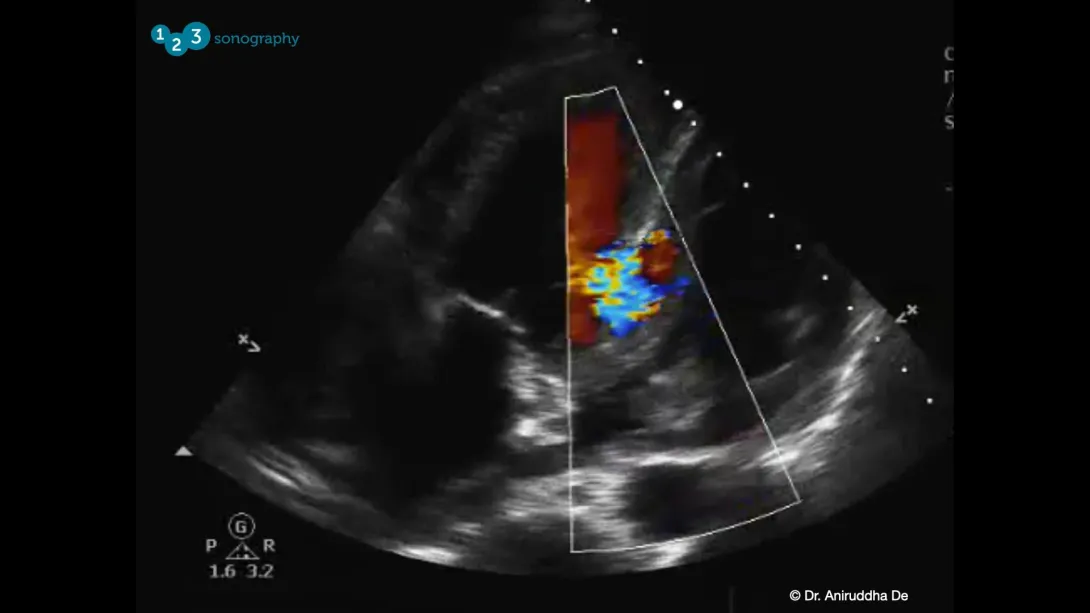 Myocardial Rupture Video 2 thumbnail.