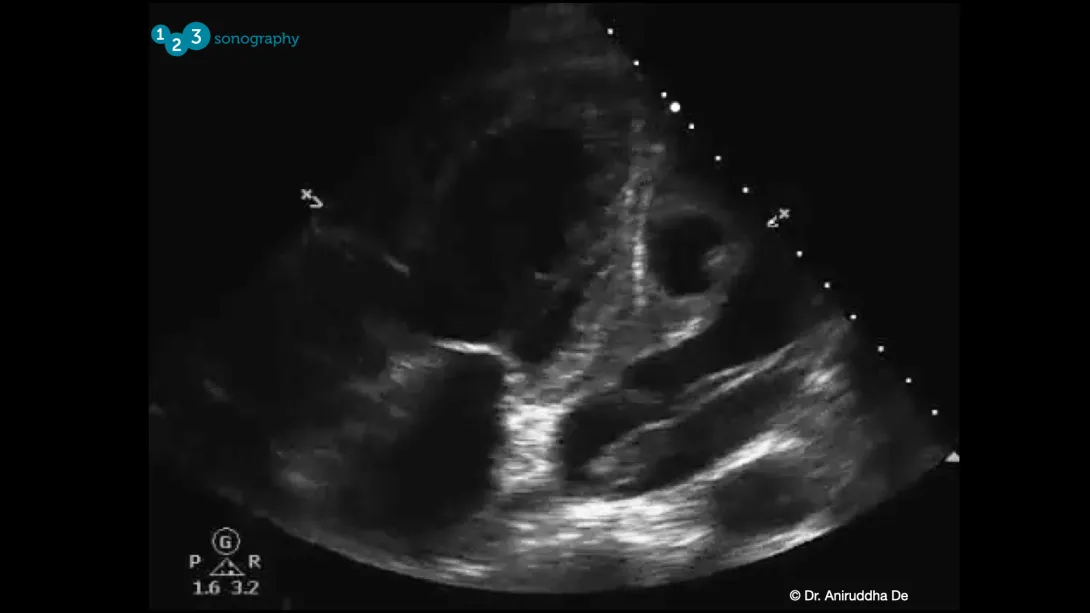 Myocardial Rupture Image.