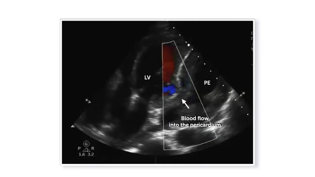 Myocardial Rupture Answer Thumbnail.