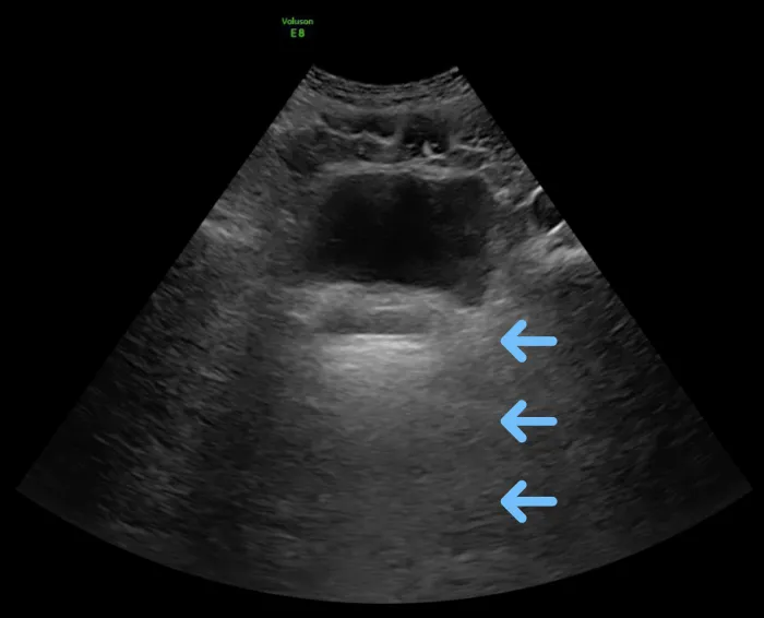 Ultrasound image of bladder with artifact.