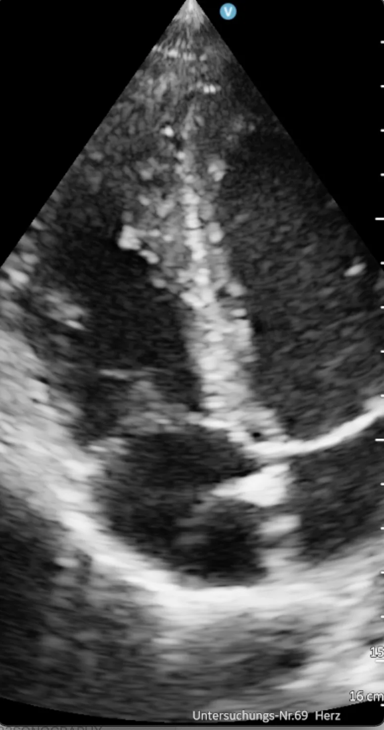Normal size and function of the right ventricle, rules out hemodynamic significant pulmonary embolism.