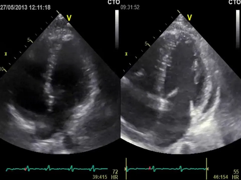Preoperative (left) and postoperative apical four-chamber view showing much less septal bounce and septal shift.