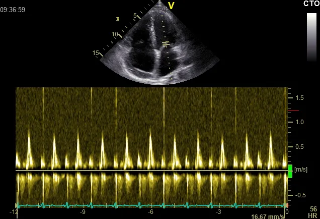 Normal pattern of mitral valve inflow with no change in maximal velocity during respiration.