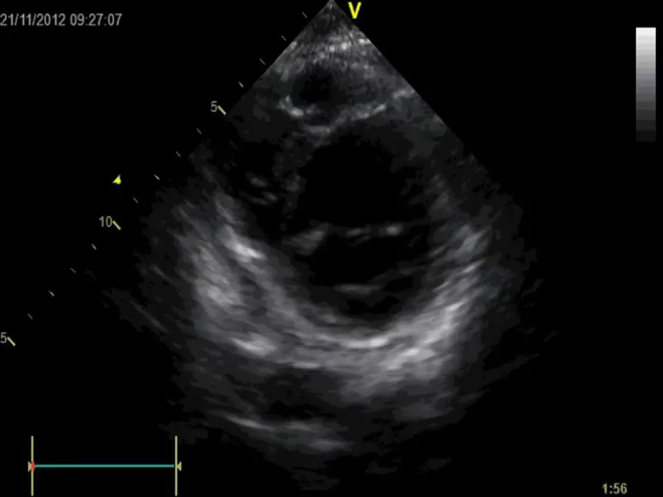 Septal bounce and leftward motion of the interventricular septum during inspiration.