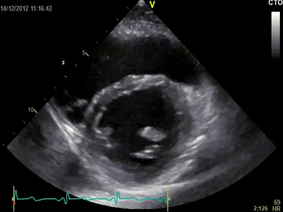 Not much has changed in respect of septal motion. He still has constrictive pericarditis.