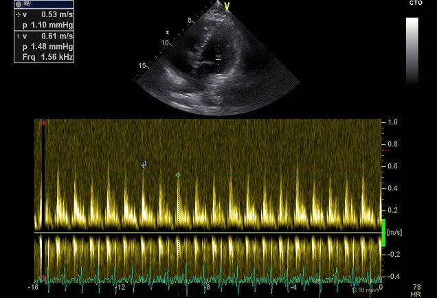 Doppler tracing of mitral valve inflow, showing a dip in maximal velocity during inspiration.