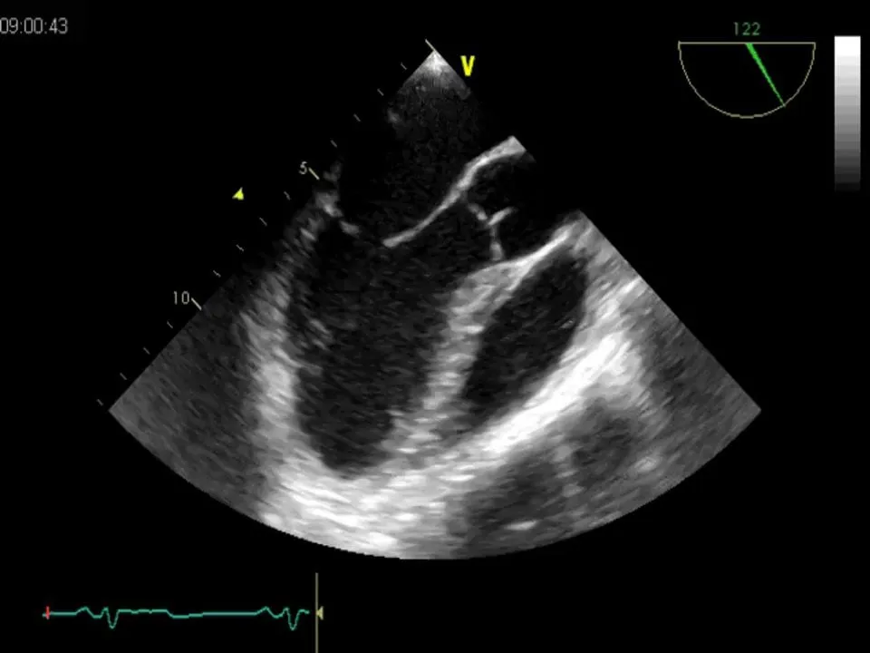 Intraoperative TEE: LVF is poor and constrictive pericarditis is still present.