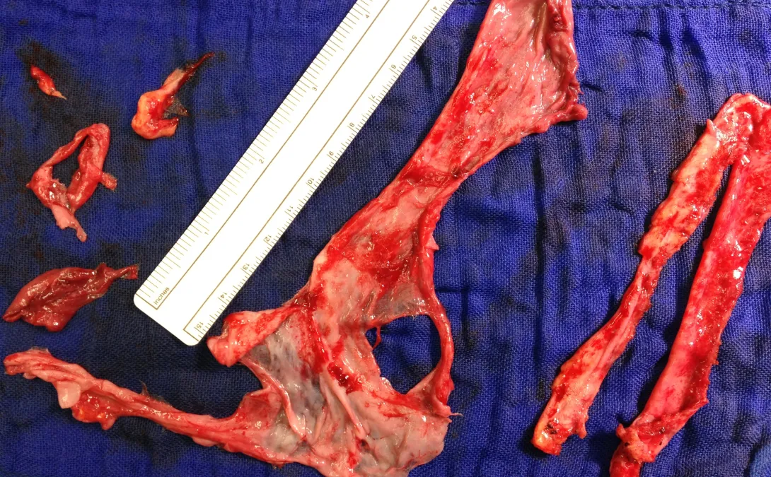 Surgical specimen: a very large quantity of fibrous tissue was removed from the heart.