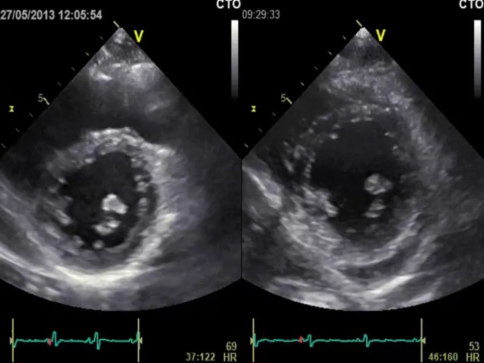 Preoperative (left) and postoperative short-axis view: note that septal bounce and septal shift are markedly reduced.