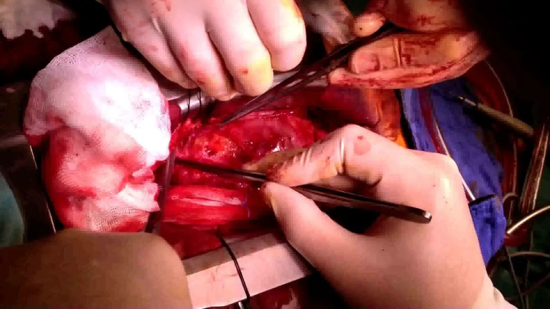 “Pericardectomy”: peeling of the fibrous layer.