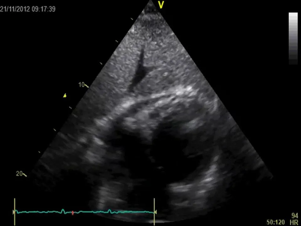 Pericarditis. Fibrinous and partially consolidated material is seen in the pericardial space.