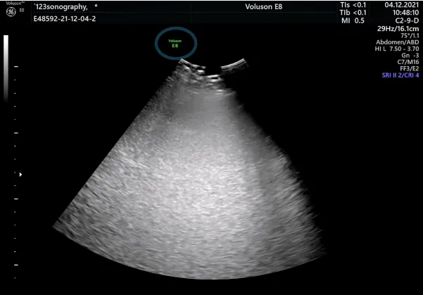 Abdominal ultrasound image.