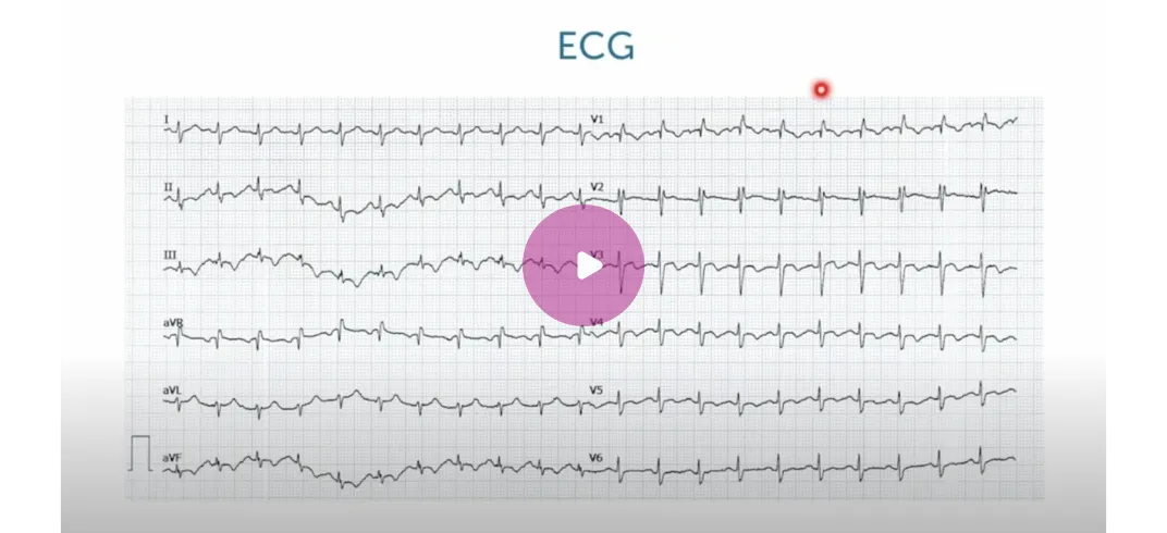 ECG thumbnail.