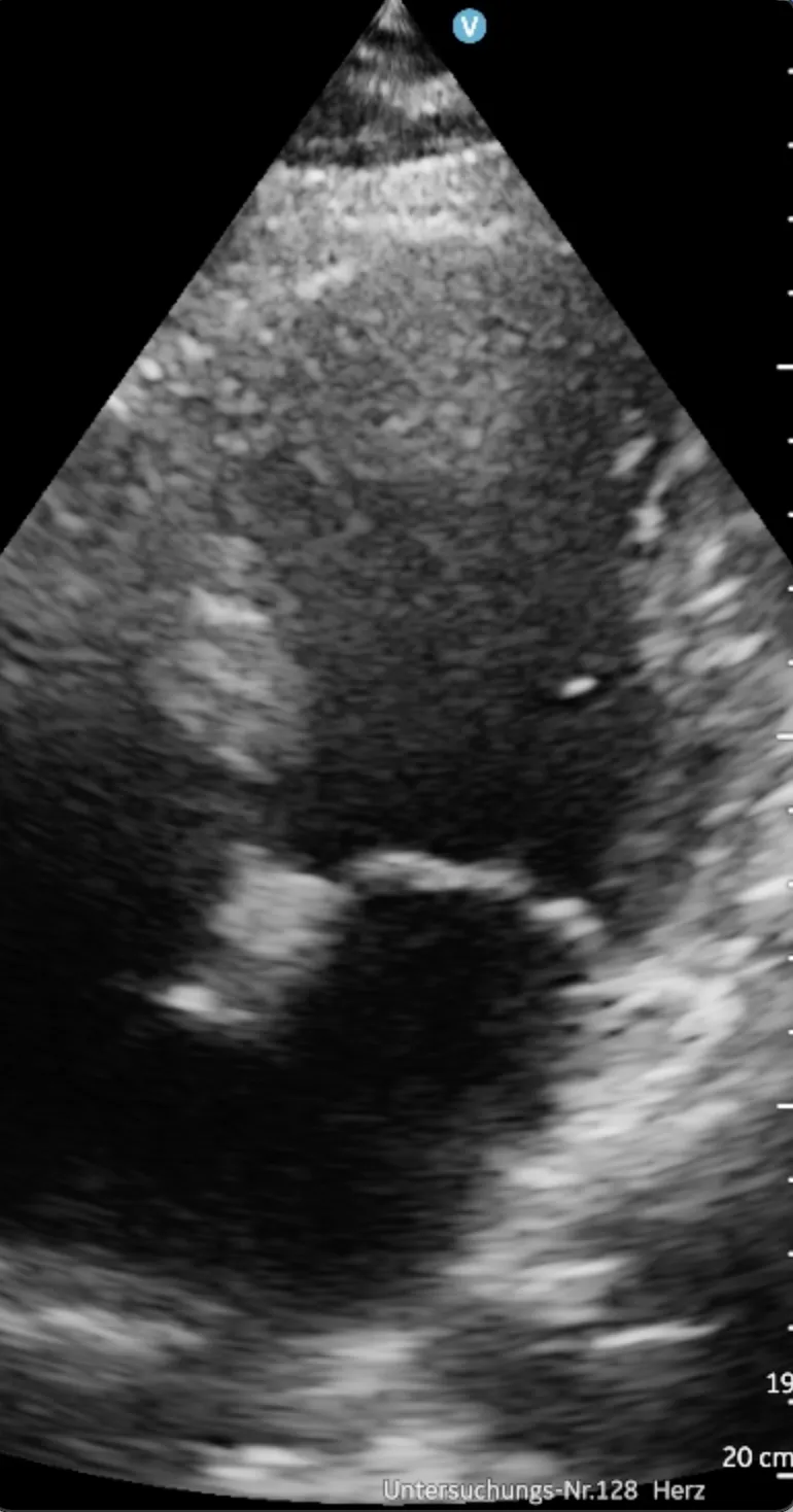 Poor left ventricular function and old Anterior myocardial infarction.
