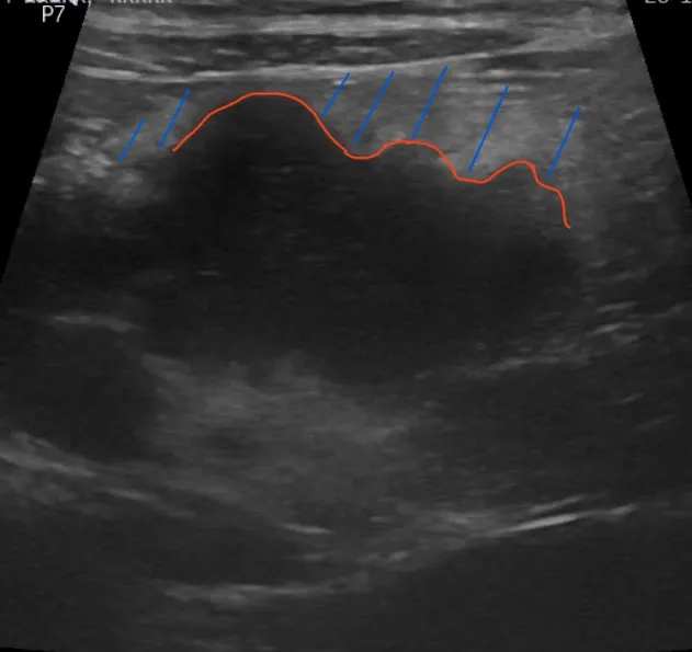 Abdominal ultrasound image with markings.
