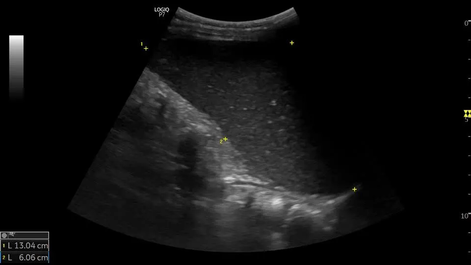 Ultrasound Image of Splenomegaly.