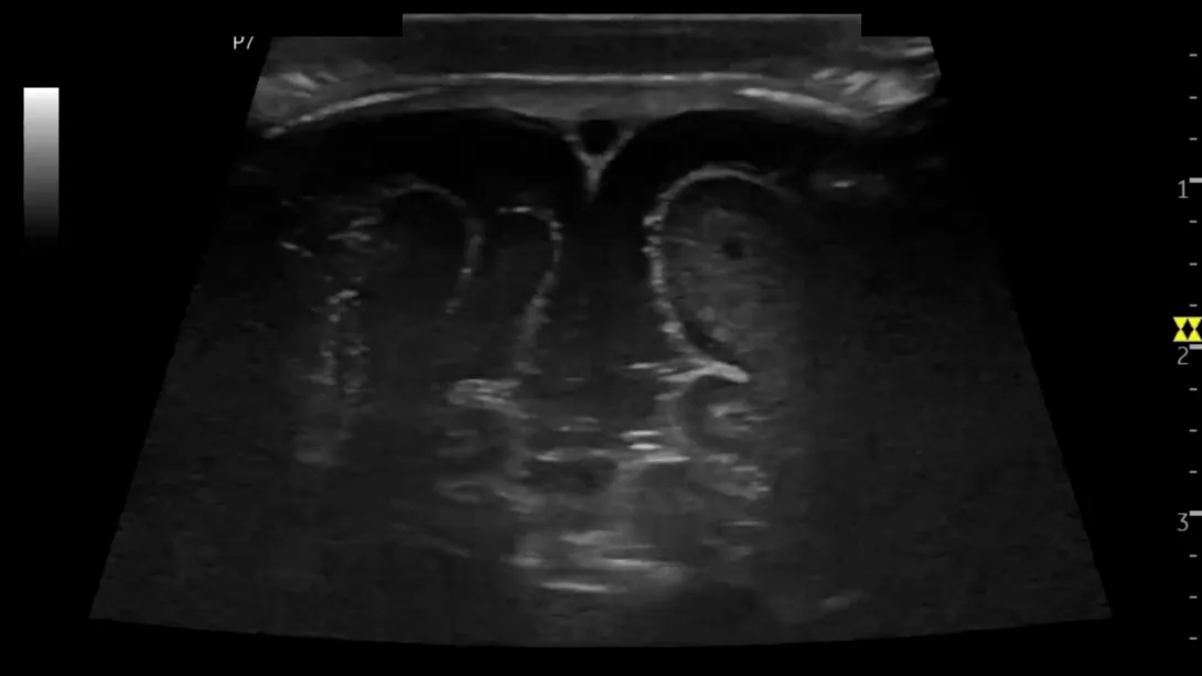 Ultrasound image of a neonatal brain ultrasound.