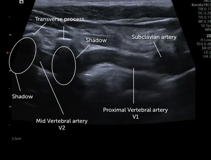 018_vertebral_artery_mid