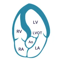 Apical five chamber view