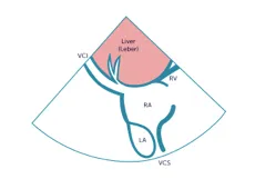 Subcostal vena cava view