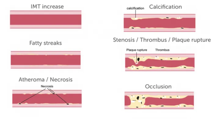 10.3_plaque_stages